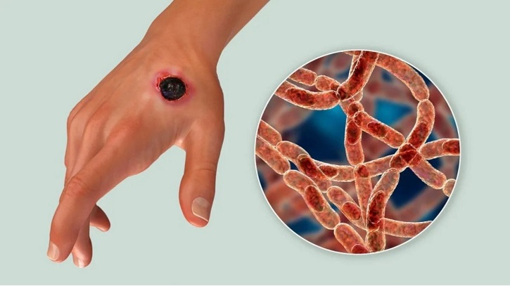 Northern Bangladesh Reports Multiple Anthrax Cases Northern Bangladesh Reports Multiple Anthrax Cases